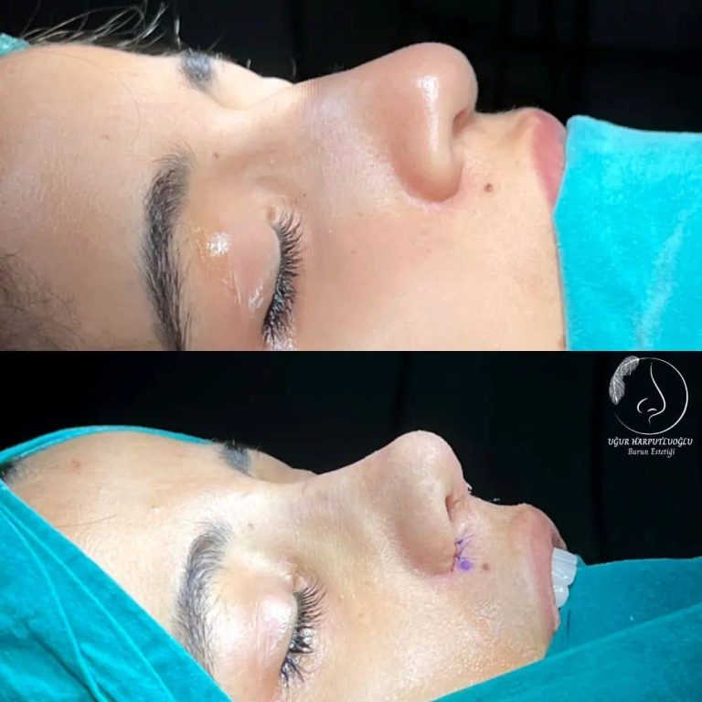 Burun Estetiği Öncesi Hazırlık Rehberi